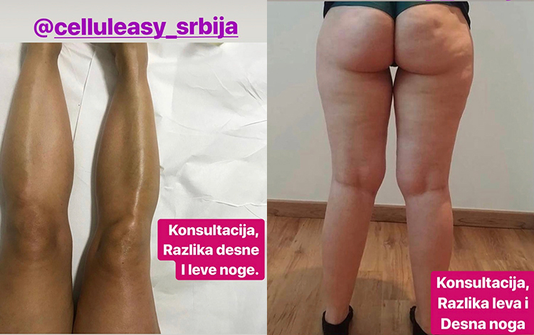 celluleasy masaža