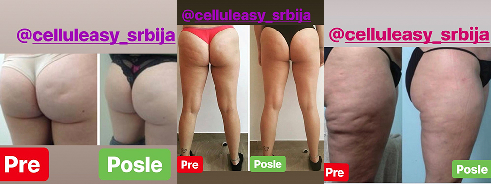 celluleasy masaža