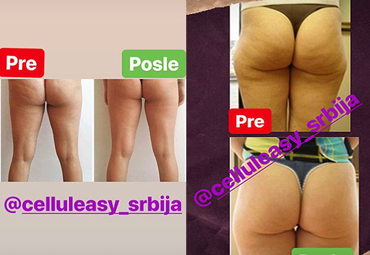 celluleasy masaža